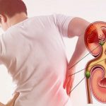 آیا مصرف الکل باعث تشکیل سنگ کلیه میشود؟