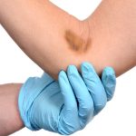 کبودی بعد از خون گیری چیست